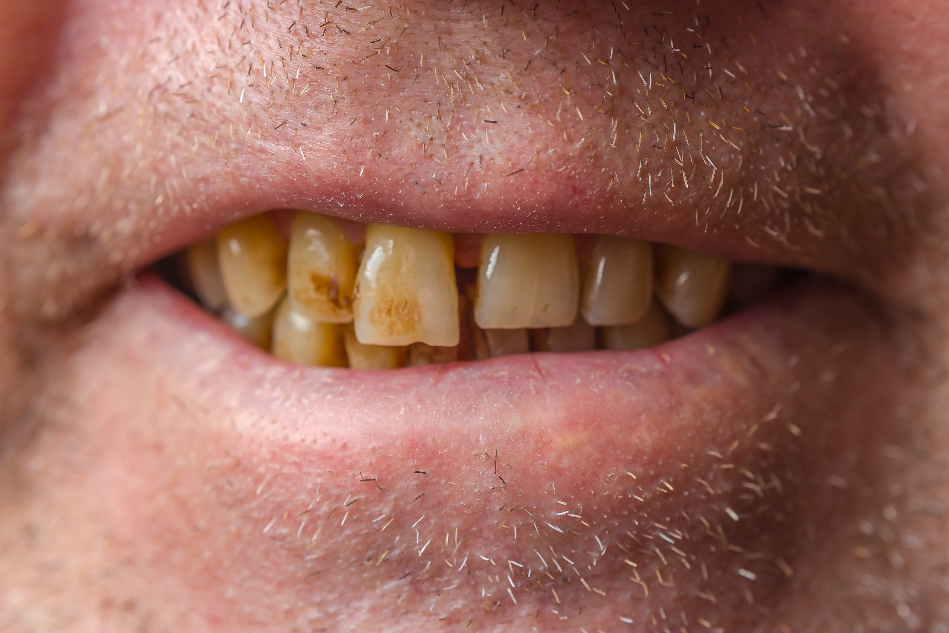 Can A Bad Tooth Cause Sores In Mouth