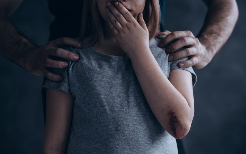 A picture of a child with a scape and bruise on her arm.